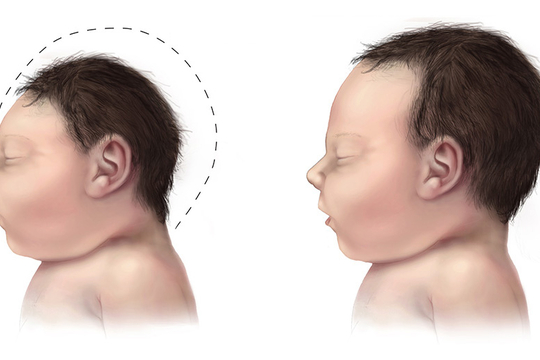 Vergelijking van de hoofdomtrek van een baby met microencefalie en een normaal ontwikkelende baby (Foto Wikipedia)