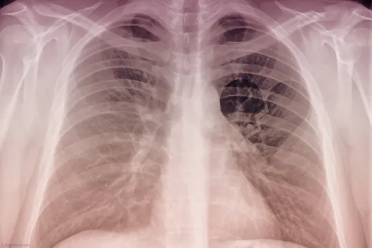 heart x-ray