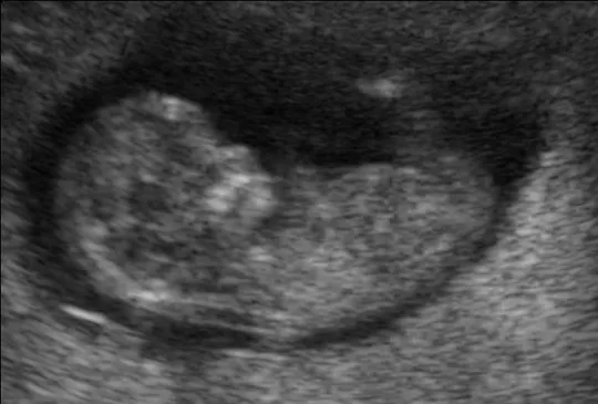 echography